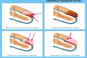 Формы поражения грибком на ногтях рук