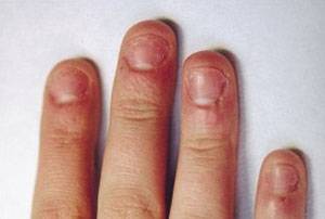Как избежать аллергии при наращивании ногтей