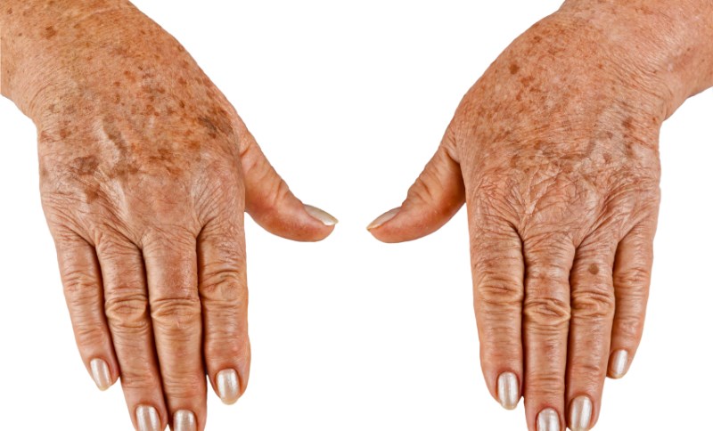 Пример возрастных изменений кожи рук