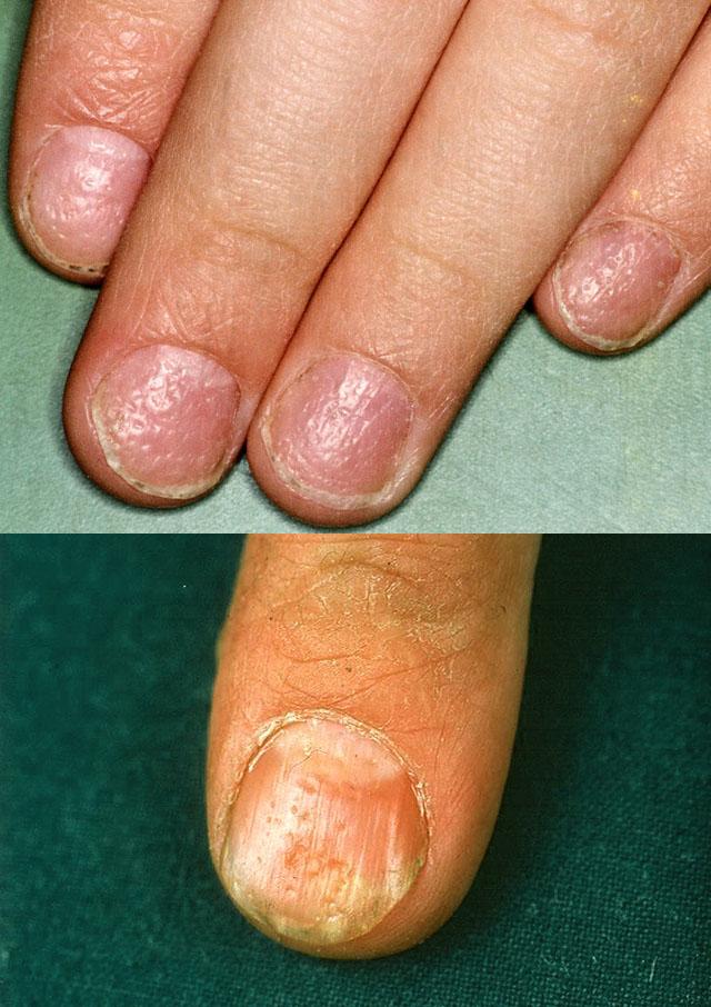 Наперсточная деформация ногтя