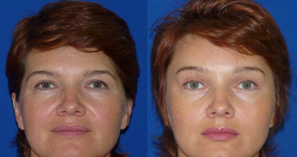 Плазменное омоложение лица – отзывы с фото до и после