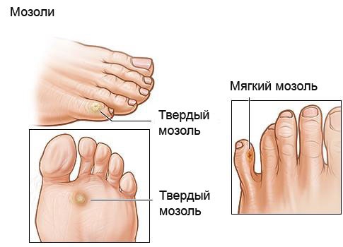 Как лечить мозоли на ногах, руках, пальцах, как избавиться от стержневой мозоли в домашних условиях