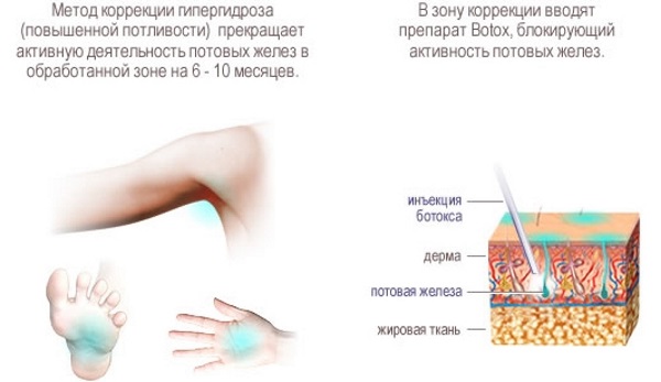 Лечение гипергидроза подмышек, ладоней, головы народными средствами, таблетками, ботулотоксином в домашних условиях