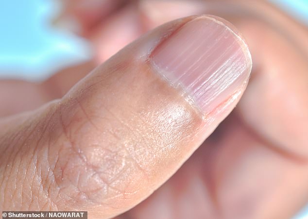 Nail ridging, an uneven or pitted surface can be linked to a variety of factors including diet, skin disorders and in some instances illness  (pictured nails with ridging)