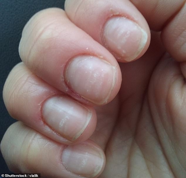 If air gets trapped between nail tissue and nails are damaged in some way, this can show up as little white dots or sometimes even lines (pictured nails with white spots)