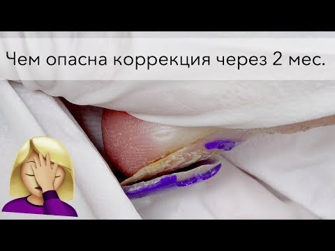 Отслойки на нарощенных ногтях. Как исправить?