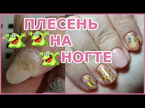 ПЛЕСЕНЬ  на ногтях после гель лака!