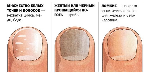 этиология деформирования ногтей