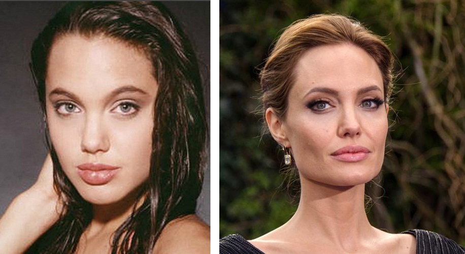 Скулы Анджелины Джоли до и после пластики