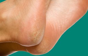 Причины шелушения кожи на ступнях