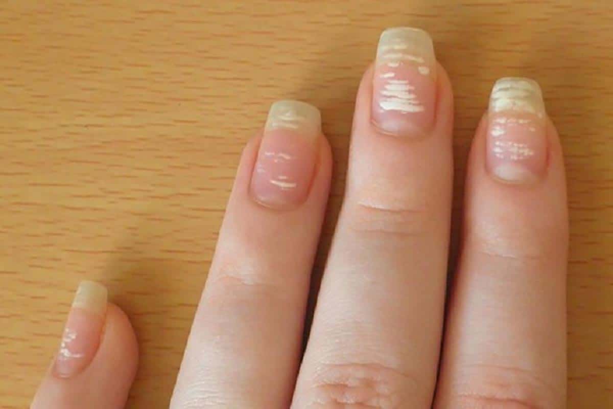 Причины ребристых ногтей на руках