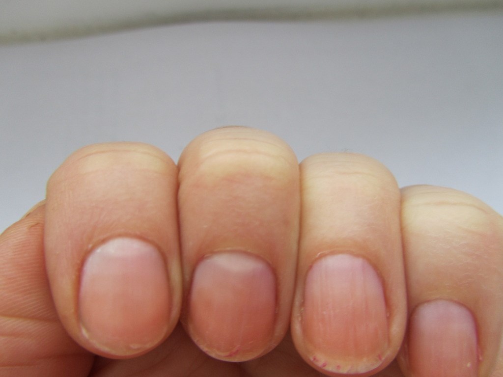 Причины ребристых ногтей на руках