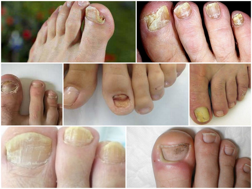 Симптомы грибка ногтей на ногах