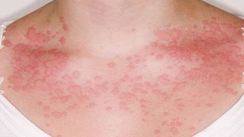 Аллергия на коже