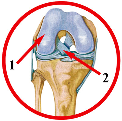 1. Титановый протез колена