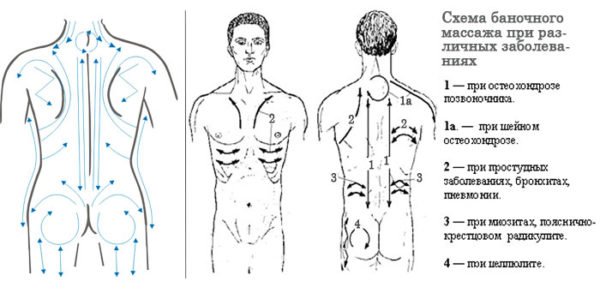 Схема кинетического баночного массажа