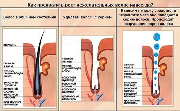 Йод и нашатырь для удаления волос