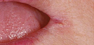 Angular cheilitis