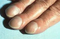 Деформация ногтей